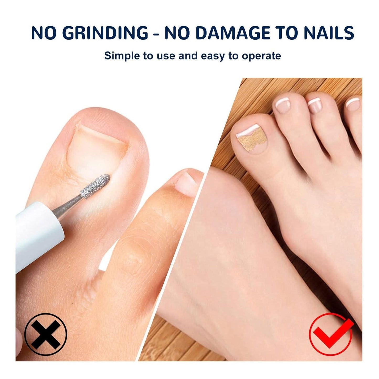 Ingrown Toenail Corrector Stickers